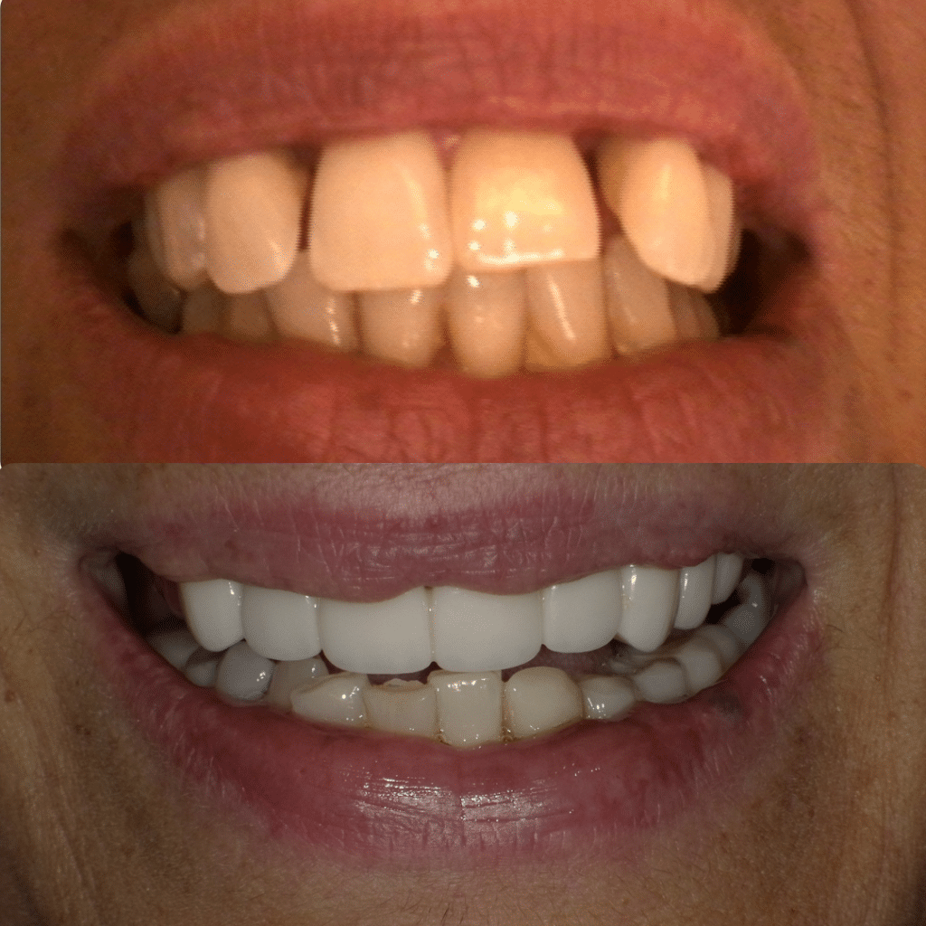 Smile Gallery Dr. James Phelan, Dr. Tyler Phelan. Exquisite Smiles. Implants, ClearCorrect, Dentures, TMD, Veneers, Full Mouth Restoration, General, Cosmetic, Restorative, Emergency Dentistry. Dentist in Attleboro, MA 02703