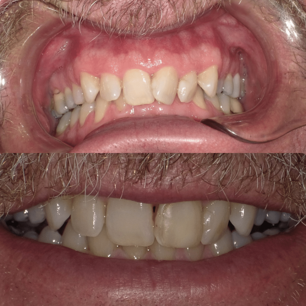 Smile Gallery Dr. James Phelan, Dr. Tyler Phelan. Exquisite Smiles. Implants, ClearCorrect, Dentures, TMD, Veneers, Full Mouth Restoration, General, Cosmetic, Restorative, Emergency Dentistry. Dentist in Attleboro, MA 02703
