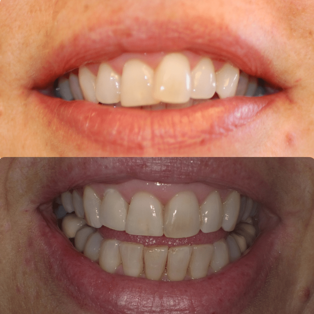 Smile Gallery Dr. James Phelan, Dr. Tyler Phelan. Exquisite Smiles. Implants, ClearCorrect, Dentures, TMD, Veneers, Full Mouth Restoration, General, Cosmetic, Restorative, Emergency Dentistry. Dentist in Attleboro, MA 02703