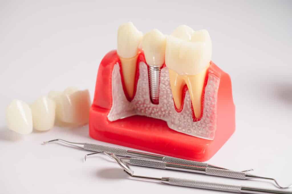 Dental Implants South Attleboro