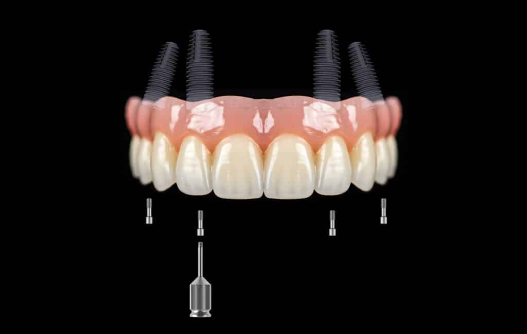 All-on-4 Dental Implants Attleboro